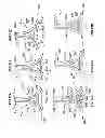 Fig. 09 - Aortic annuloplasty ring