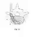 Fig. 14 - Expandable fusion device for positioning between adjacent vertebral bodies