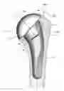 Fig. 01 - Modular reverse shoulder prostheses