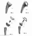 Fig. 02 - Modular reverse shoulder prostheses