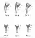 Fig. 12 - Modular reverse shoulder prostheses