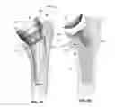 Fig. 14 - Modular reverse shoulder prostheses