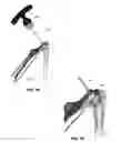 Fig. 16 - Modular reverse shoulder prostheses