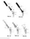 Fig. 17 - Modular reverse shoulder prostheses