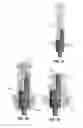 Fig. 20 - Modular reverse shoulder prostheses