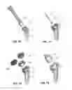 Fig. 21 - Modular reverse shoulder prostheses