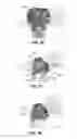 Fig. 25 - Modular reverse shoulder prostheses