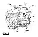Fig. 08 - Surgical guide for implanting a knee prosthesis