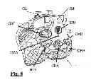 Fig. 09 - Surgical guide for implanting a knee prosthesis