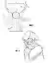 Fig. 02 - CPAP mask skin adhesive applicator