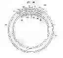 Fig. 06 - Expandable Inter Vivos Tube