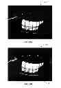Fig. 22 - METHODS AND APPARATUSES FOR DETERMINING CONTACT LENS INTOLERANCE IN CONTACT LENS WEARER PATIENTS BASED ON DRY EYE TEAR FILM CHARACTERISTIC ANALYSIS AND DRY EYE SYMPTOMS