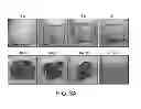 Fig. 06 - METHODS FOR TREATING UV-DAMAGED SKIN AND SCC TUMORS AND FOR REMOVING TATTOOS WITH TOPICAL INGENOL MEBUTATE