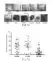 Fig. 11 - METHODS FOR TREATING UV-DAMAGED SKIN AND SCC TUMORS AND FOR REMOVING TATTOOS WITH TOPICAL INGENOL MEBUTATE