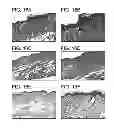 Fig. 22 - METHODS FOR TREATING UV-DAMAGED SKIN AND SCC TUMORS AND FOR REMOVING TATTOOS WITH TOPICAL INGENOL MEBUTATE