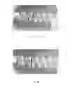 Fig. 02 - Mandibular attachment for correction of malocclusion