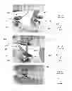 Fig. 03 - Mandibular attachment for correction of malocclusion