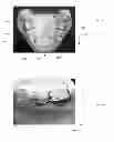 Fig. 06 - Mandibular attachment for correction of malocclusion