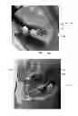 Fig. 07 - Mandibular attachment for correction of malocclusion