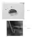 Fig. 08 - Mandibular attachment for correction of malocclusion