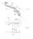 Fig. 09 - Mandibular attachment for correction of malocclusion