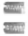Fig. 01 - MANDIBULAR ATTACHMENT FOR CORRECTION OF MALOCCLUSION