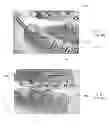 Fig. 04 - MANDIBULAR ATTACHMENT FOR CORRECTION OF MALOCCLUSION