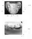 Fig. 06 - MANDIBULAR ATTACHMENT FOR CORRECTION OF MALOCCLUSION