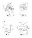 Fig. 07 - Dental cutting system and method with remote cutting guide