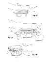 Fig. 18 - Dental cutting system and method with remote cutting guide