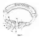 Fig. 07 - Matrix ring for tooth restoration