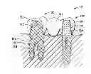 Fig. 01 - Dental bridge
