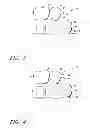 Fig. 03 - Dental bridge