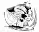 Fig. 01 - Female urinary incontinence device