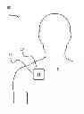 Fig. 01 - Disposable Vibratory Apparatus