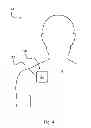 Fig. 05 - Disposable Vibratory Apparatus