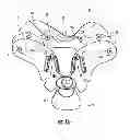 Fig. 02 - Cervical collar with cable adjustment system