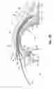 Fig. 07 - Method and apparatus for reducing intraocular pressure of an eye