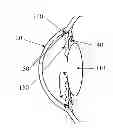 Fig. 01 - Intraocular pressure sensor with external pressure compensation