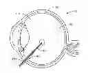 Fig. 01 - Vitrectomy probe with adjustable cutter port size