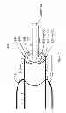 Fig. 03 - METHOD OF BACKFLOW REDUCTION DURING MATERIAL DELIVERY THROUGH A NEEDLE INTO TISSUE