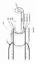 Fig. 04 - METHOD OF BACKFLOW REDUCTION DURING MATERIAL DELIVERY THROUGH A NEEDLE INTO TISSUE