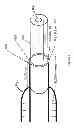 Fig. 05 - METHOD OF BACKFLOW REDUCTION DURING MATERIAL DELIVERY THROUGH A NEEDLE INTO TISSUE