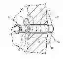 Fig. 01 - Extensible internal bolster for a medical device