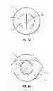 Fig. 04 - Extensible internal bolster for a medical device