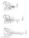 Fig. 09 - APPARATUS AND SYSTEMS FOR ROTARY OSTEOTOMY