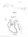 Fig. 02 - System for leadless pacing of the heart