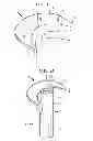 Fig. 02 - Apparatus and method for heart valve repair