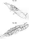 Fig. 09 - Apparatus and method for heart valve repair