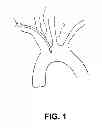 Fig. 02 - Intravascular blood filters and methods of use